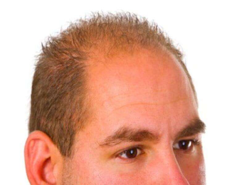 Haartransplantation