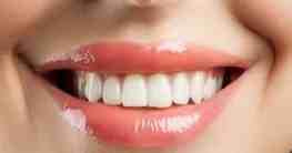 Weiße Zähne - So hellen Sie Ihre Zähne auf
